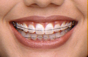 Advanced Bracket System With Metal or Clear Braces